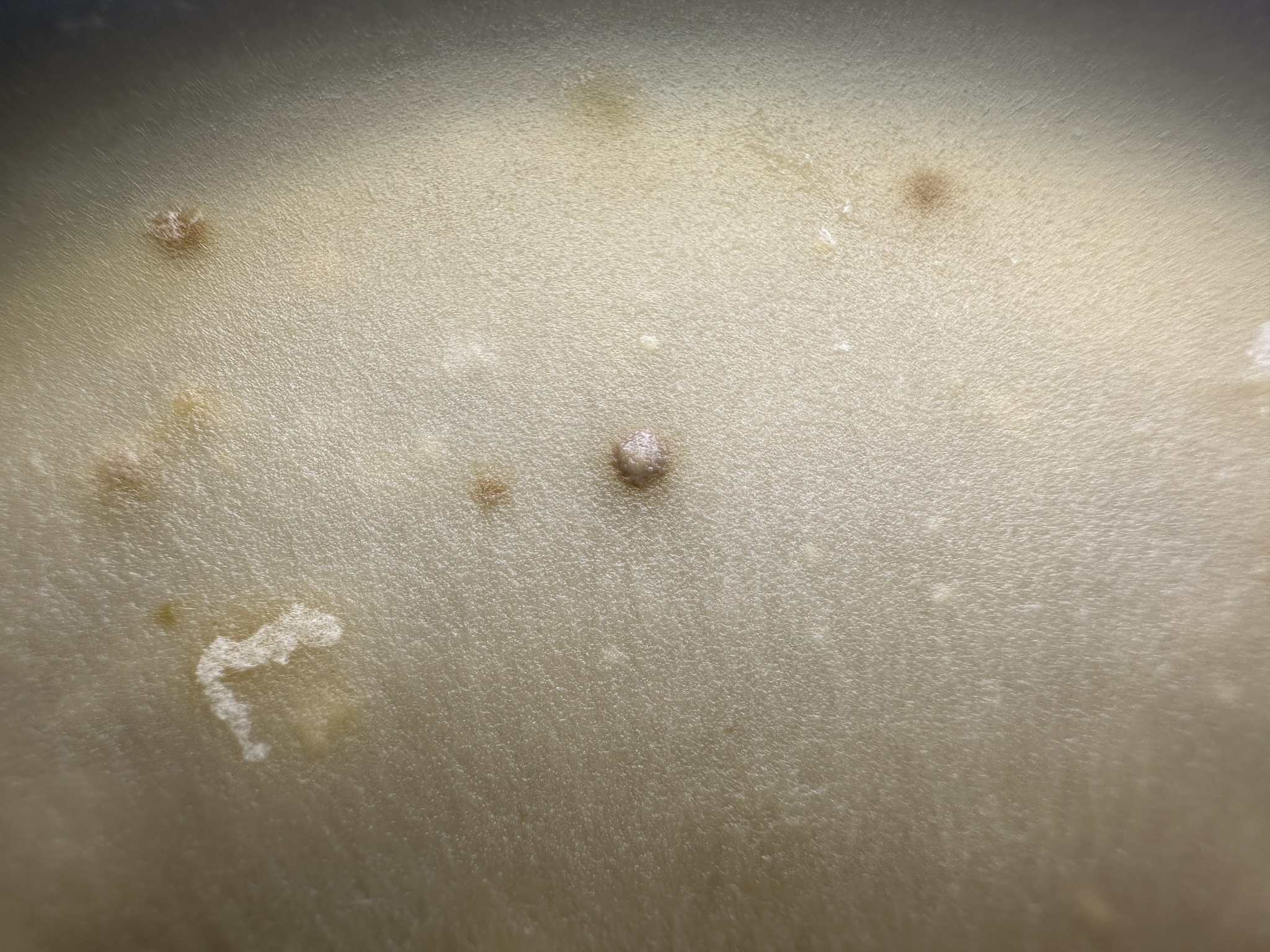 Plectosphaerella cucumerina